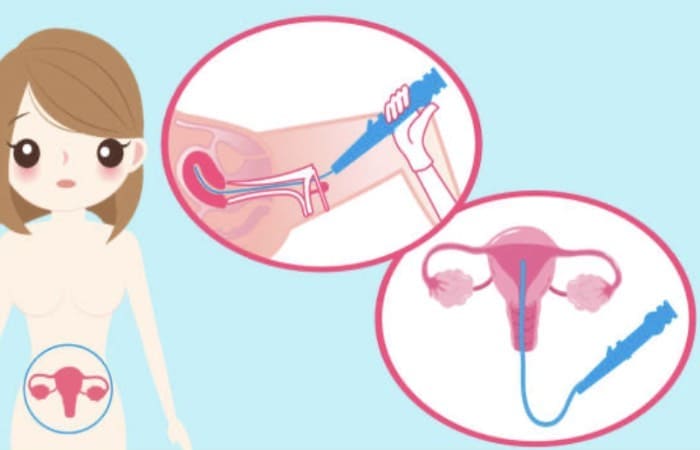 Histeroscopia diagnostica-terapeutica